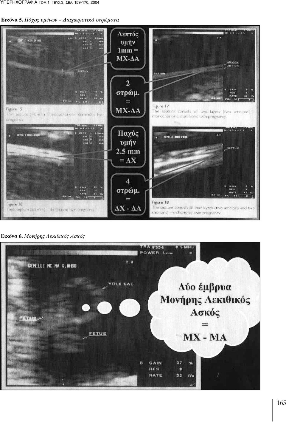 Πάχος υμένων Διαχωριστικά