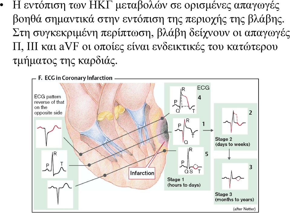 Στη συγκεκριμένη περίπτωση, βλάβη δείχνουν οι απαγωγές Π,