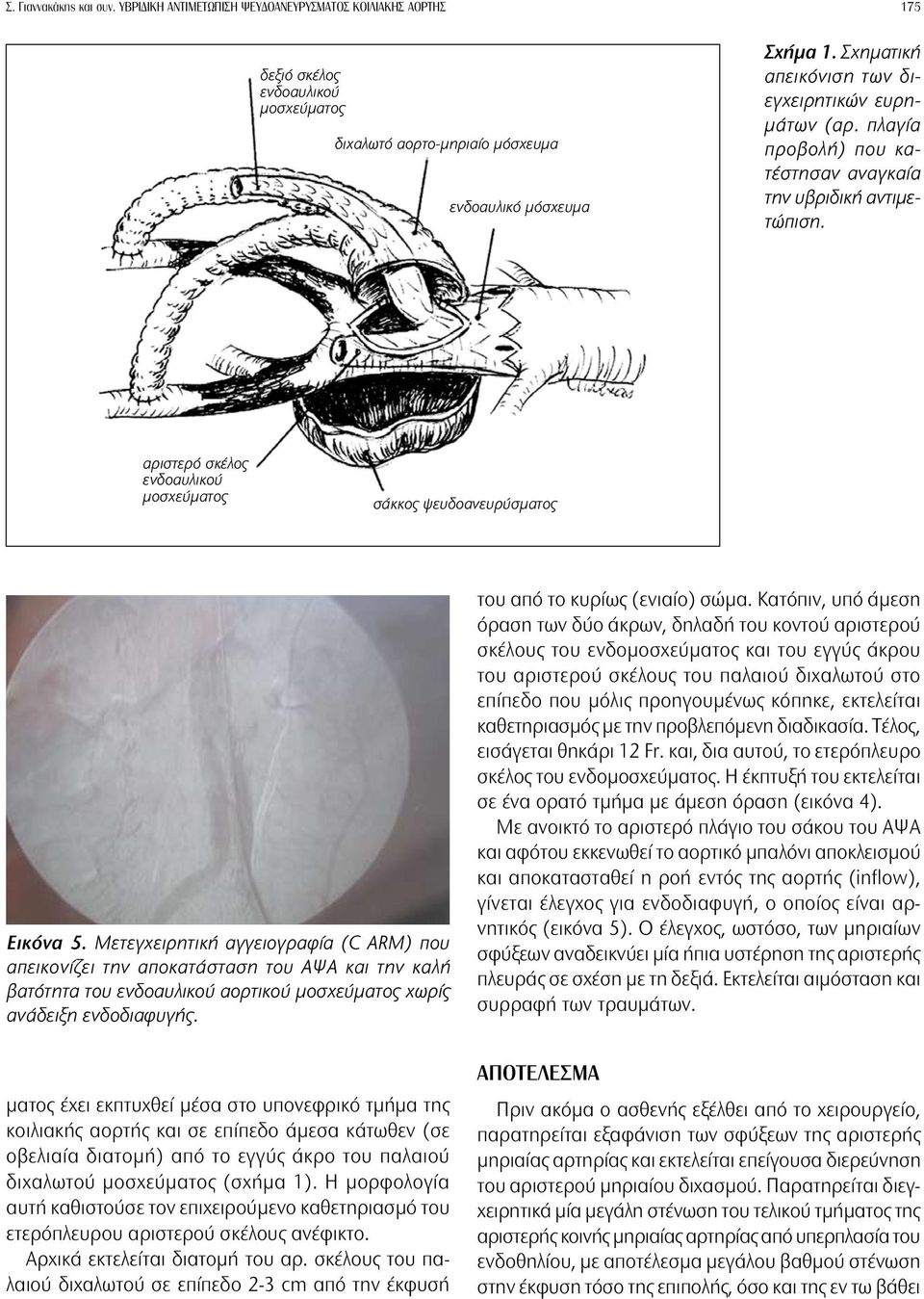 Μετεγχειρητική αγγειογραφία (C ARM) που απεικονίζει την αποκατάσταση του ΑΨΑ και την καλή βατότητα του ενδοαυλικού αορτικού μοσχεύματος χωρίς ανάδειξη ενδοδιαφυγής.