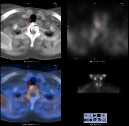 MIBI EARLY MIBI LATE SPECT/CT 4D-CT Γυναίκα Στη SPECT/CT 65 ετών με π- το εύρημα εντοπίζεται δίπλα στη ΥΠΠΘ. πρόσθια Στη επιφάνεια του Θ1 σπονδύλου.