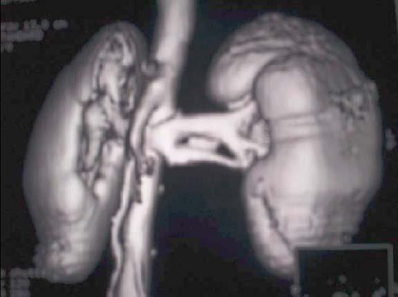 Nutcracker syndrome Σύνθλιψη της ΑΡ νεφρικής φλέβας μεταξύ αορτής και άνω μεσεντέριας αρτηρίας Διάγνωση Echo ±Doppler US CT αγγειογραφία Μαγνητική αγγειογραφία Shin J et al.