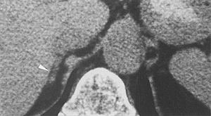 ΑΝΑΤΟΜΙΑ Φυσιολογικά Επινεφρίδια - CT Το δεξιό επινεφρίδιο κείται 1-2 εκ. πάνω από τον άνω πόλο του δεξιού νεφρού και ακριβώς πίσω από την κάτω κοίλη φλέβα.