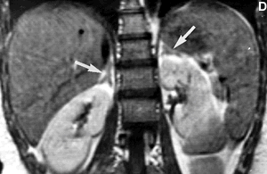 ΑΝΑΤΟΜΙΑ Φυσιολογικά Επινεφρίδια-MRI Τ1-w σε εγκάρσιο επίπεδο χωρίς