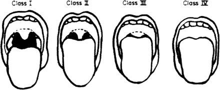 απόσταση μεταξύ των κοπτήρων κατά το άνοιγμα του στόματος μικρότερο από 3 εκατοστά, μη ορατότητα της σταφυλής όταν κάθονται και προβάλλουν προς τα έξω τη γλώσσα τους, θολωτό ή πολύ στενό σχήμα
