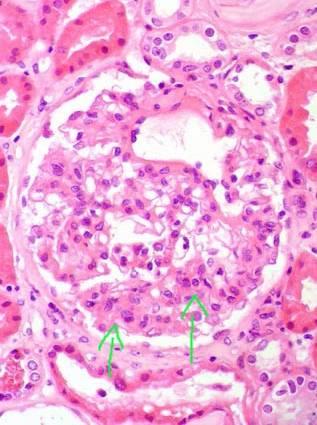 Νεφρίτιδα του ΣΕΛ τάξης ΙΙ Περιοχές του μεσαγγείου με κυτταρική υπερπλασία στο φωτομικροσκόπιο.