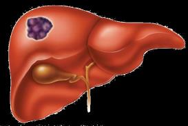 Comparative study of resection and radiofrequency ablation in the treatment of solitary colorectal liver metastases. Amer J Surg. 2009;197:728-736.