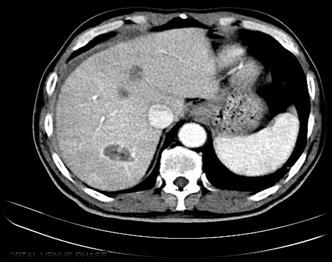 Proportion Surviving Proportion Surviving RF Ablation: CRC Metastases Overall Survival by surgery type 1.0 0.8 0.6 0.4 0.2 RFA Resection p < 0.