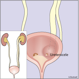 ΟΥΡΗΤΗΡΟΚΗΛΗ κυστική διάταση του ενδοκυστικού ουρητήρα