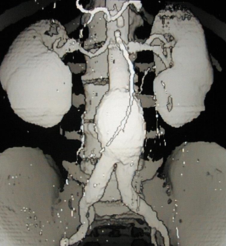 CT Aγγειογραφία με ΜSCT Απεικόνιση των αγγείων μετά την χορήγηση ενδοφλέβιου