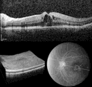 Κίνδυνοι με τη χορήγηση Fingolimod Cardiovascular disease risk Macular edema Bradycardia AV block Teratogenic potential Lymphopenia and risk of infection Approximately 6 weeks for lymphocyte counts
