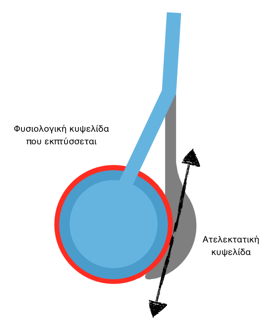 Εικόνα 1.2 Peff Papp x (V/Vo) 2/3, όπου P είναι η εφαρμοζόμενη πίεση, V o όγκος της εκπτυσσόμενης κυψελίδας και Vo ο όγκος της ατελεκτατικής κυψελίδας.