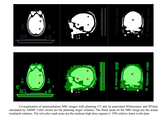 Patient-specific phantom created with 3-D printing technology and polymer gel dosimetry Liu H et al, Dosimetric validation