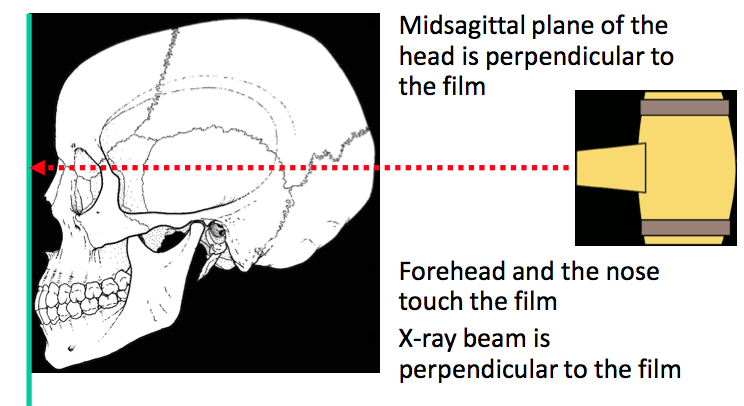 Οπισθοπρόσθια (μετωπορρινική) Τοποθέτηση ασθενή: Κεντρική ακτίνα παράλληλη στο έδαφος Σημείο επικέντρωσης στον αυχένα,