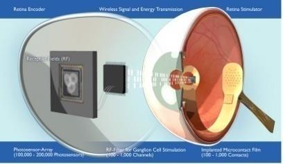 Motion Accelerometer Cochlear Implant Artificial Intra-Urethral