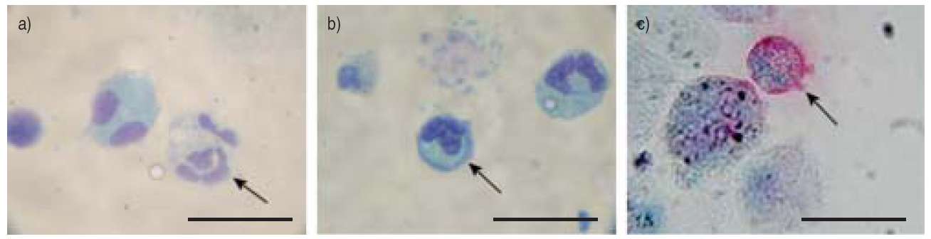 Reduced Eosinophil Apoptosis in