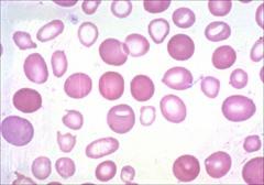 Ταξινόμηση Αναιμίας ανάλογα με την περιεκτικότητα Αιμοσφαιρίνης των Ερυθρών MCH <27 pg: 27-34 pg Υπόχρωμη Ορθόχρωμη Fe