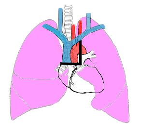 πιθανότητες να έχουν και πίεση ενσφήνωσης > 18 mm Hg σε σχέση με ασθενείς που δεν έχουν αυτά τα ακτινογραφικά ευρήματα, θέτοντας έτσι τη διάγνωση του καρδιογενούς πνευμονικού οιδήματος (Εικόνα 5.