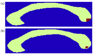 Εικόνα 5: Διαχωρισμός υπο περιοχών με μορφολογικές διαφοροποιήσεις από την υλοποίηση (a) DPR με χρήση Bonferroni και FDR, p<0.0008, q = 0,54και (b) ανάλυση κατά pixel, με χρήση FDR, p<0.