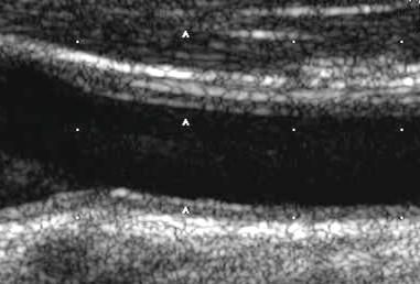 bifurcation Common carotid artery bulb CCA bulb CCA Το IMT είναι μια φυσιολογική δομή αποτελούμενη κατά