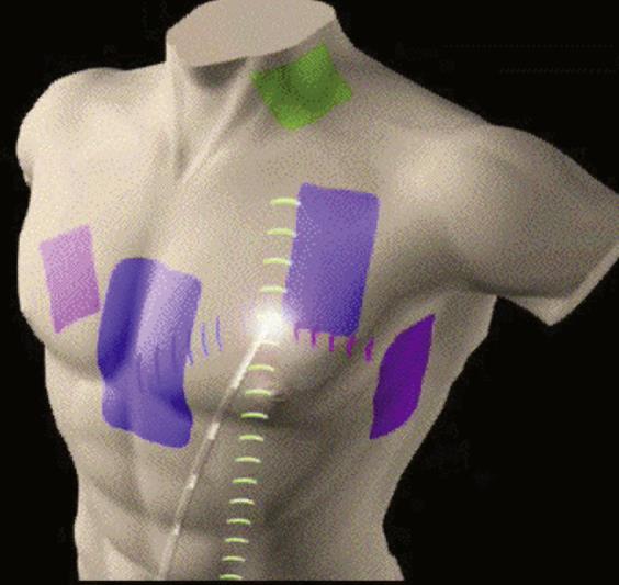 based mapping NavX 3D transthoracic