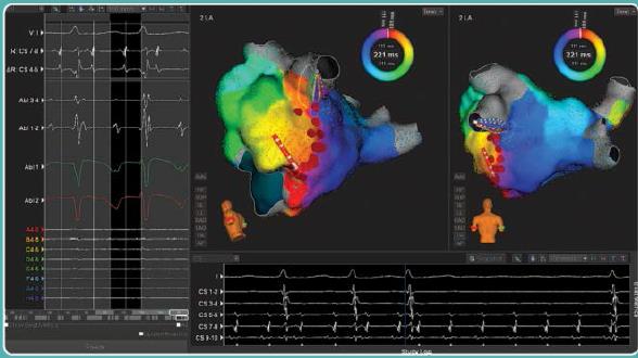 Rhythmia TM Mapping