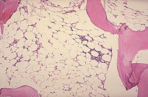 Διερεύνηση κυτταροπενίας με χαμηλό αριθμό ΔΕΚ Μυελόγραμμα + βιοψία μυελού Μειωμένη κυτταροβρίθεια μυελού με μείωση όλων των αιμοποιητικών σειρών Άπλαστική αναιμία ιδιοπαθής, δευτεροπαθής Παροξυσμική