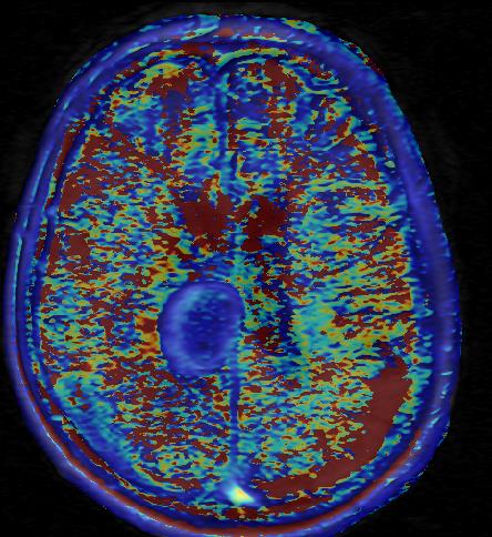 T2*DSC KAI T1DSC PERFUSION CBV και Ktrans συσχετίζονται με τους μοριακούς δείκτες VEGF/VPF και ιστοπαθολογικές