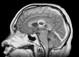 TUMOR GRADING FLAIR Σημαντικό διηθητικό