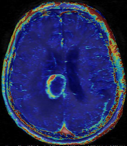 ΝΕΟΠΛΑΣΙΑ ΚΑΙ MULTI-B DIFFUSION Intravoxel Incoherent Motion Diffusion-Weighted Imaging (IVIM) derived metrics