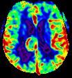 IMAGING 2016;44:620 632 F,ederau et al. AJNR Am J Neuroradiol 35:256 62 Feb 2014, Bisdas et al.