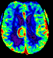 diffusionweighted imaging, perfusion-weighted imaging, and permeability maps, along with H-MRS, may enhance the accuracy of the