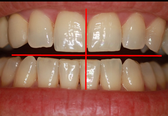 Εικόνα 1.12: Οπίσθια δόντια. Το κάθε δόντι έχει μια συγκεκριμένη θέση στον οδοντικό φραγμό, η οποία προσδιορίζεται από δύο στοιχεία: α) σε ποια γνάθο βρίσκεται και β) σε ποιο ημιμόριο.