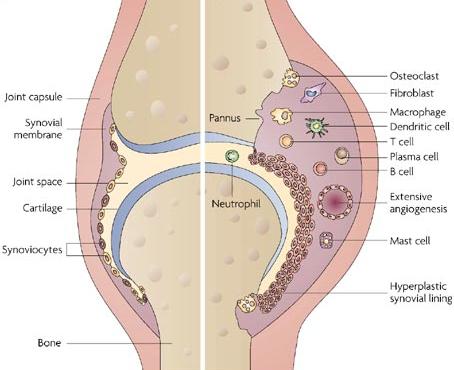πολλαπλασιασμός και διόγκωση αρθρικών κυττάρων λαχνωτός αρθρικός υμένας