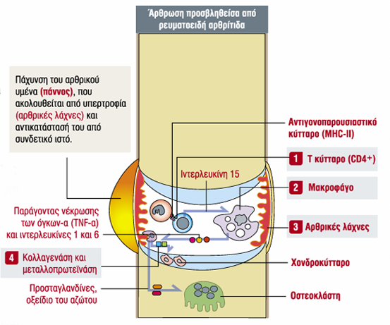 Ρευματοειδής αρθρίτιδα Φυσιολογική άρθρωση Άρθρωση προσβληθείσα από ρευματοειδή