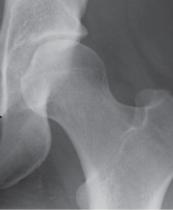 ABSENCE OF RADIOGRAPHIC PROGRESSION OF HIP ARTHRITIS IN PATIENTS WITH ANKYLOSING SPONDYLITIS TREATED WITH INFLIXIMAB FOR 6 YEARS Maria Konsta 1, Vassiliki K. Bournia 1, Petros P.