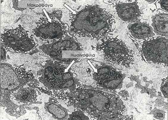 Φωτογραφία ηλεκτρονικού µικροσκοπίου αρκετών µακροφάγων και 2 ηωσινόφιλων σε µια περιοχή γειτονικά ενός