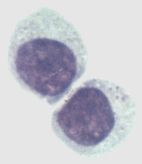 Ιδιότητες ΝΚ κυττάρων Τα ΝΚ κύτταρα είναι κυτταροτοξικά, φονεύουν καρκινικά κύτταρα και κύτταρα μολυσμένα με ιούς ή βακτήρια.
