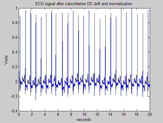 ΚΕΦΑΛΑΙΟ 2 Τεχνικές ανίχνευσης QRS συμπλέγματος ηλεκτροκαρδιογράφημα στο οποίο είναι εμφανή τα Q, R, S σημεία, ενώ στο