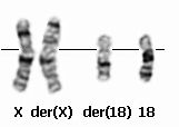 t(21;22)(q22;q12) (EWSRI- ERG fusion gene) Συνοβιακό σάρκωμα