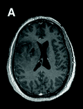 MRI Περιορισμοί Καθήλωση σχετιζόμενη με διάσπαση του αιματεγκεφαλικού φραγμού Λιγότερο χρήσιμη σε μη σκιαγραφούμενους όγκους ανεξαρτήτως ιστοπαθολογίας (όπως χαμηλόβαθμα γλοιώματα )