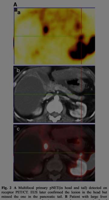 Non functional NET with multiple liver metastases (CUP).