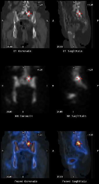 Ολόσωμο Scan Οστών SPECT/CT : Μεγάλο οστεόφυτο στον Ο5 CT
