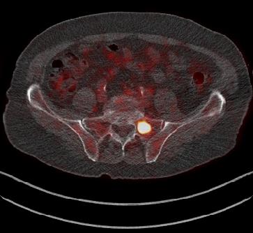 FDG-PET/CT PET CT FUSION Οστική μετάσταση