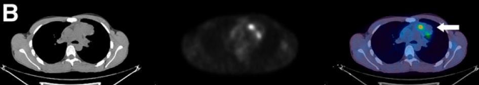 FDG-PET/CT σε επανασταδιοποίηση μετά το τέλος της θεραπείας Δυο περιστατικά λεμφώματος μετά ΧΜΘ, με υπολειμματική μάζα στη CT.