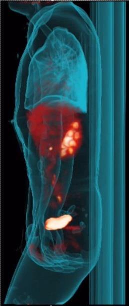 FDG-PET/CT στον έλεγχο της ανταπόκρισης στη θεραπεία GIST ορθού πριν και κατά τη