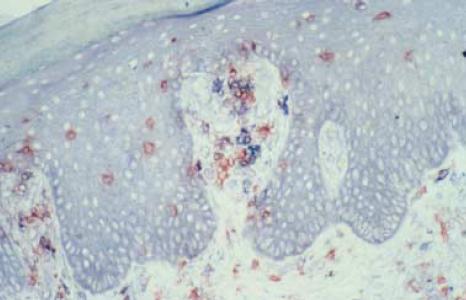 Ψωρίαση: νόσος Τ-κυττάρων