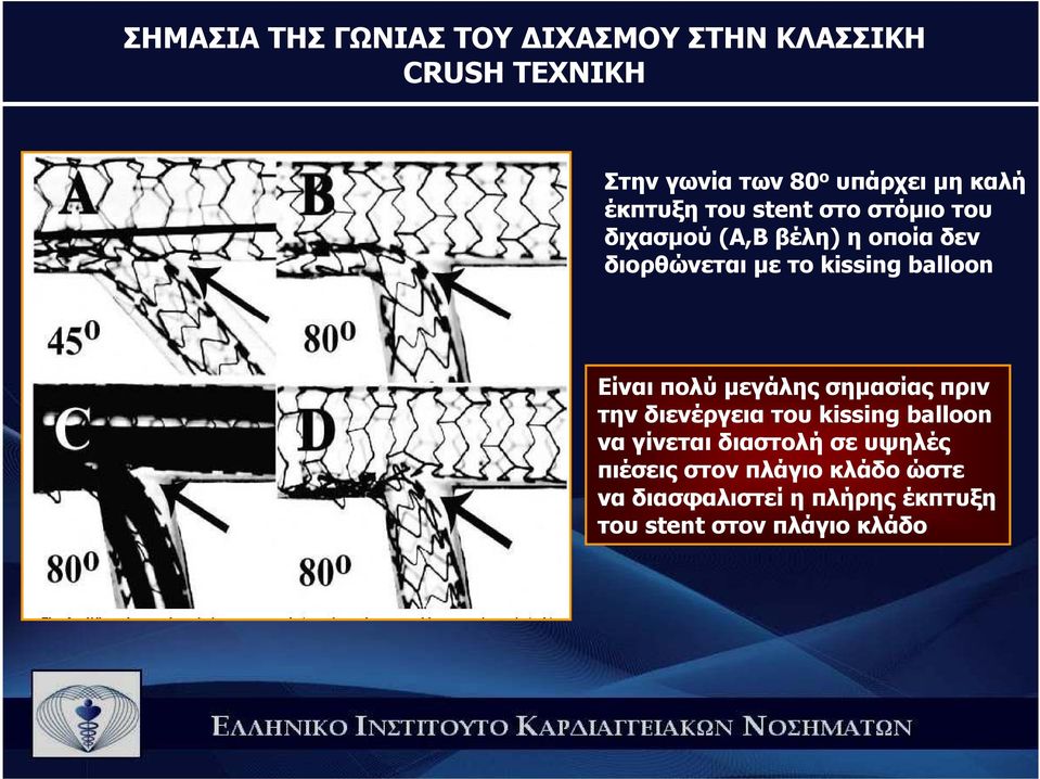 balloon Είναι πολύ µεγάλης σηµασίας πριν την διενέργεια του kissing balloon να γίνεται διαστολή