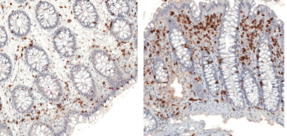 Increase of CD3 in the