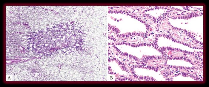 Ταξινόμηση αδενοca πνεύμονα κατά IASLC/ATS/ERS/WHO,2015 ΑδενοCa in situ <3cm, κατά μήκος των κυψελίδων (lepidic growth) Συνήθως μη βλεννώδες 100% DFS