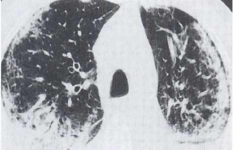 Ηωσινοφιλική Πνευμονία (Χρόνια) - Παράλληλες με το θωρακικό τοίχωμα περιοχές πύκνωσης - Διαγνωστικό, όχι